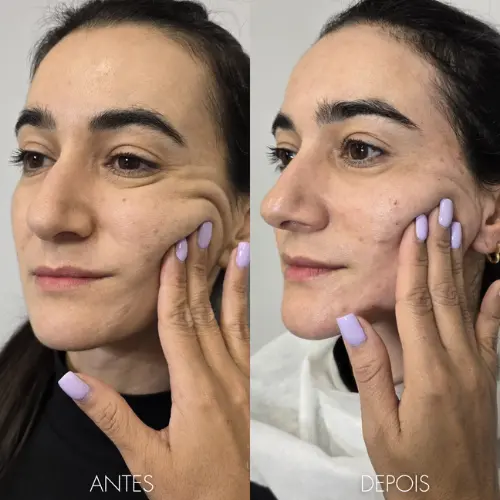 Imagem - Menos Flacidez - Kaesthetcs