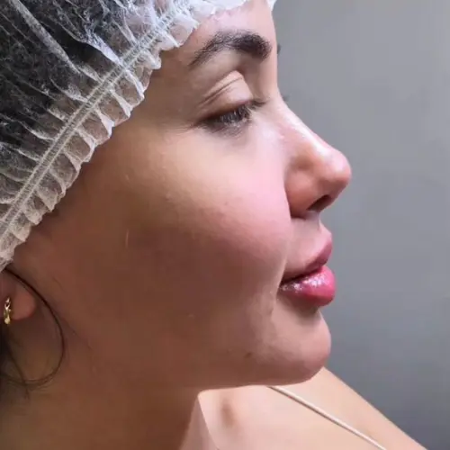 Imagem - Preenchimento labial - Kaesthetcs