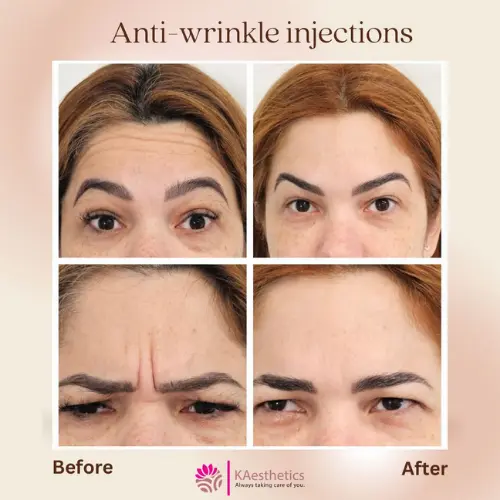 Injeções anti-rugas - Kaesthetics