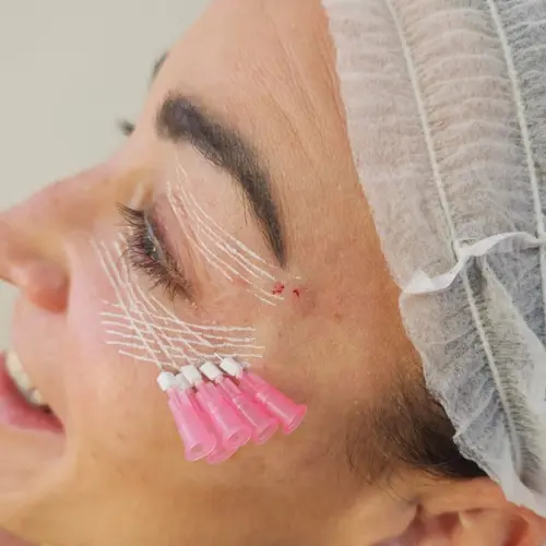 Lifting Facial Agulhas - Kaesthetics