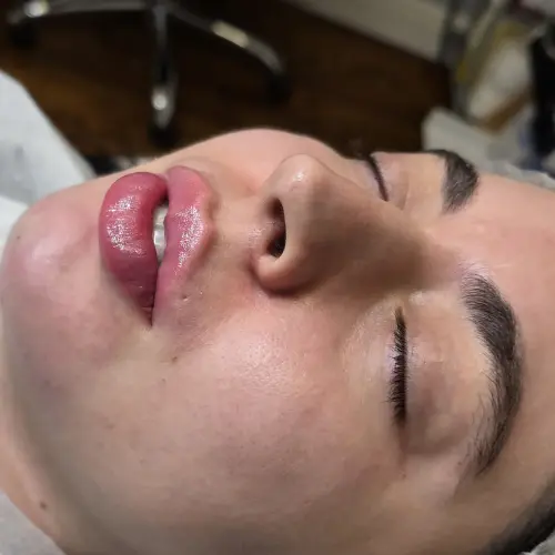 Preenchimento Labial - Kaesthetics