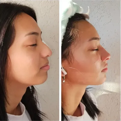 Rinomodelação - Kaesthetics