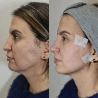 Imagem - Lifting facial - Kaesthetcs