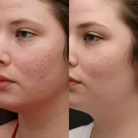 Imagem - Tratamento de Pele - Kaesthetcs