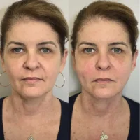 Preenchimento de dérmicos - Kaesthetcs